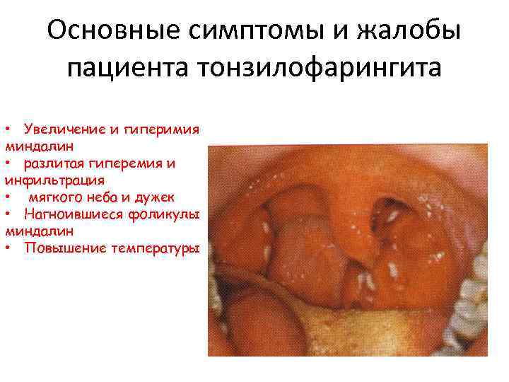 Основные симптомы и жалобы пациента тонзилофарингита • Увеличение и гиперимия миндалин • разлитая гиперемия