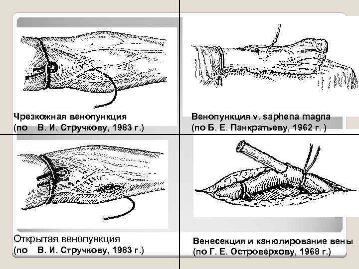 Чрезкожная венопункция (по В. И. Стручкову, 1983 г. ) Венопункция v. saphena magna (по