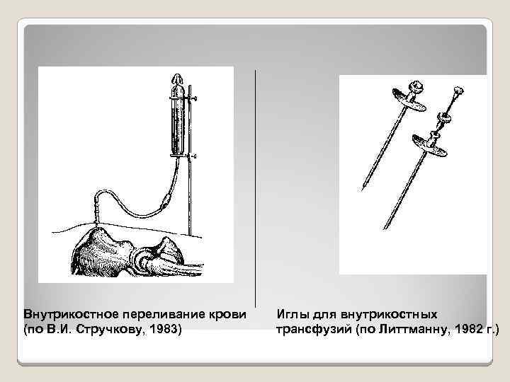 Внутрикостное переливание крови (по В. И. Стручкову, 1983) Иглы для внутрикостных трансфузий (по Литтманну,