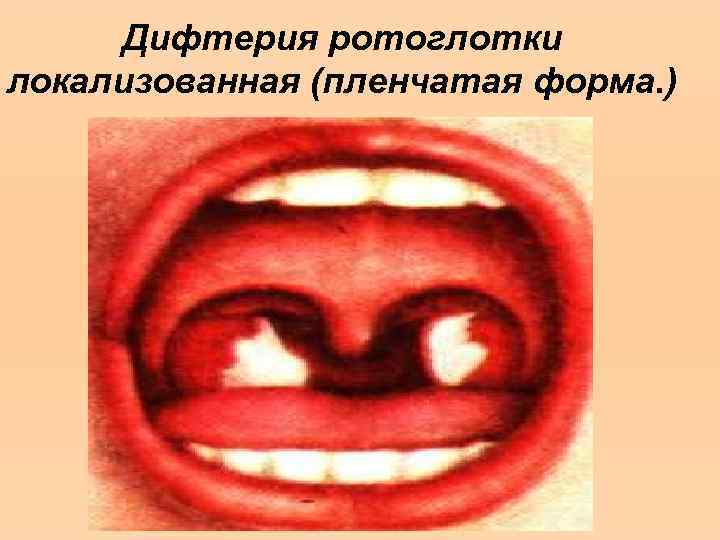 Дифтерия ротоглотки локализованная (пленчатая форма. ) 