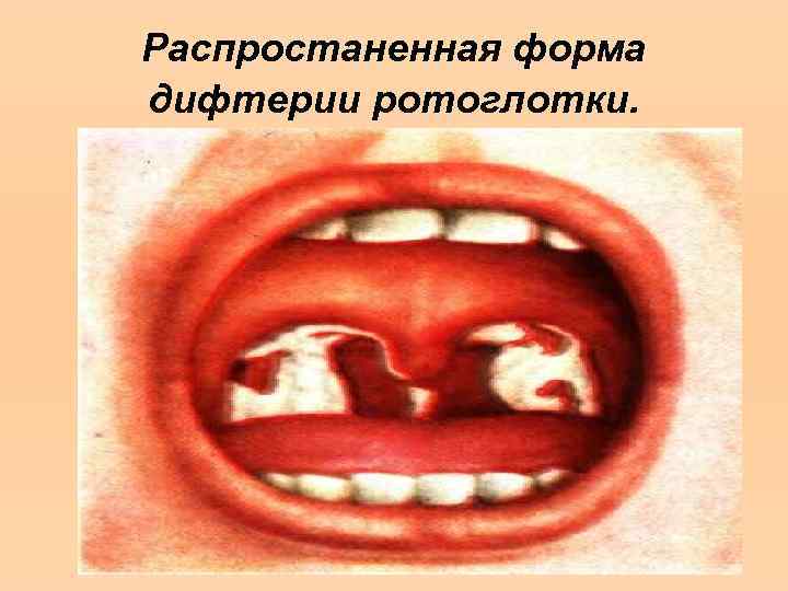 Распростаненная форма дифтерии ротоглотки. 