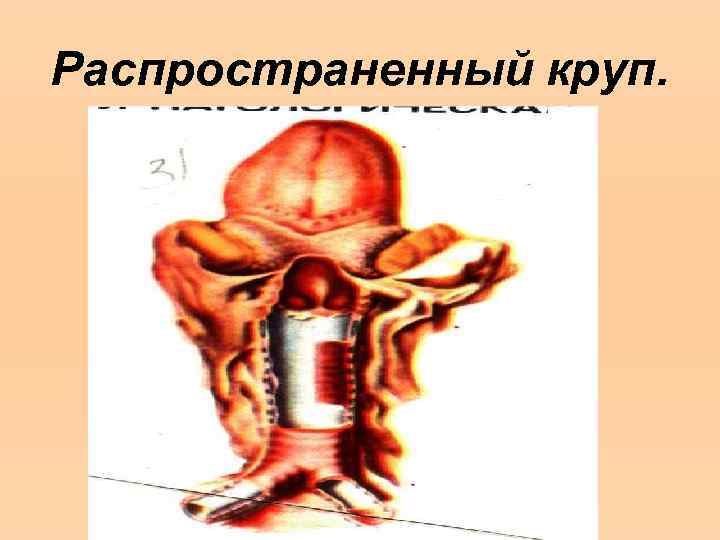Распространенный круп. 