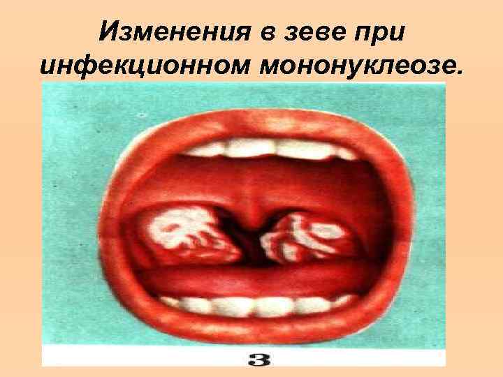 Изменения в зеве при инфекционном мононуклеозе. 
