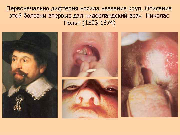 Первоначально дифтерия носила название круп. Описание этой болезни впервые дал нидерландский врач Николас Тюльп