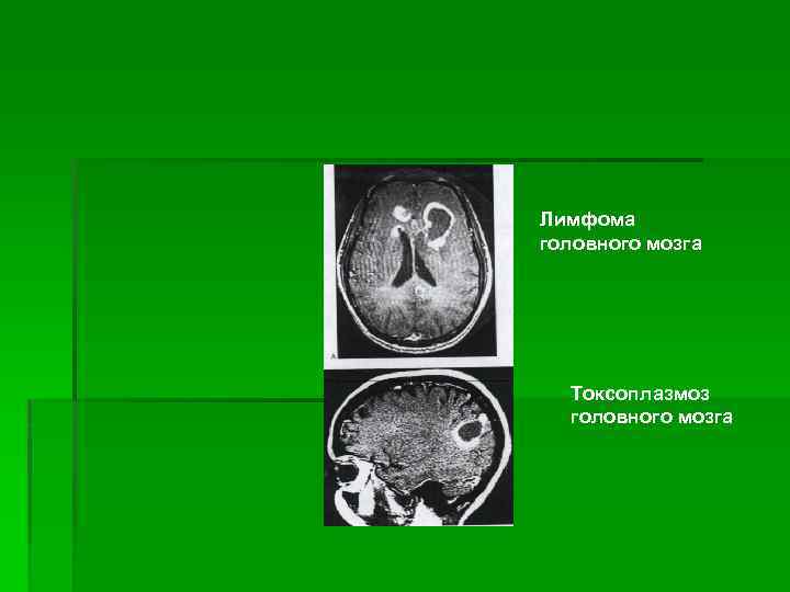 Лимфома головного мозга Токсоплазмоз головного мозга 