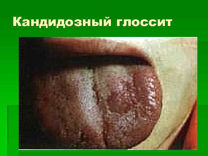 Кандидозный глоссит 