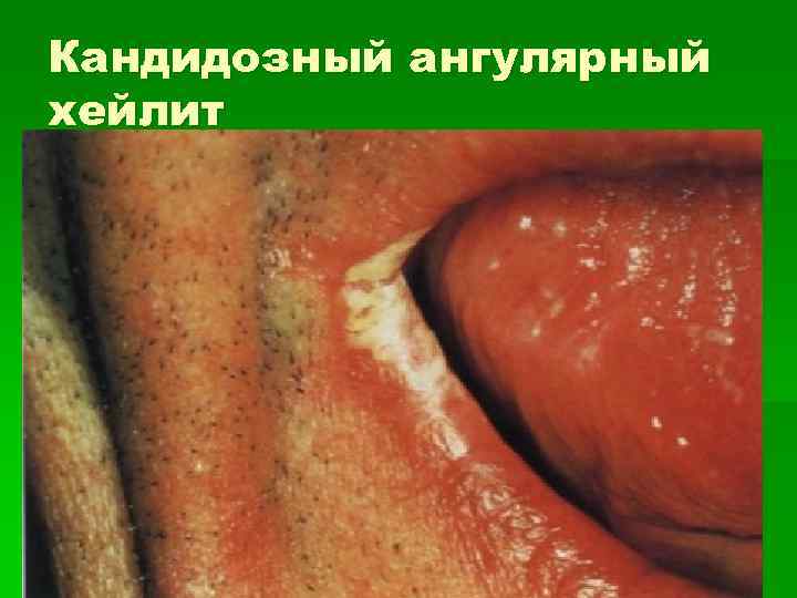 Кандидозный ангулярный хейлит 