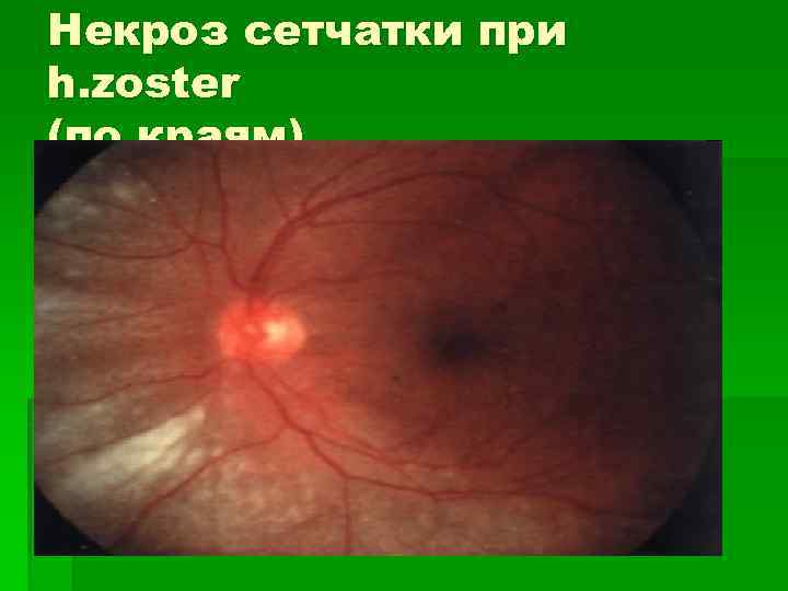 Некроз сетчатки при h. zoster (по краям) 