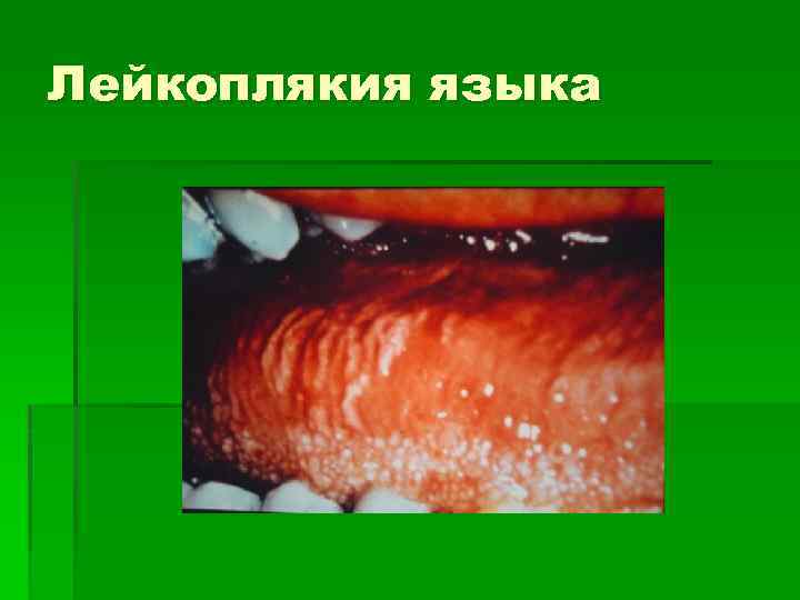 Лейкоплякия языка 