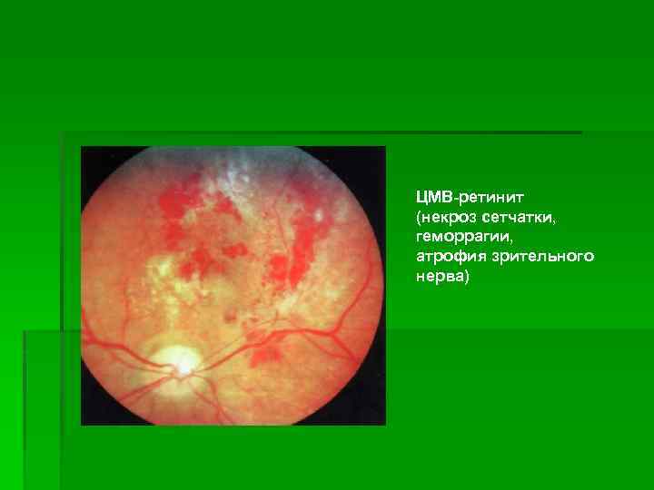 ЦМВ-ретинит (некроз сетчатки, геморрагии, атрофия зрительного нерва) 