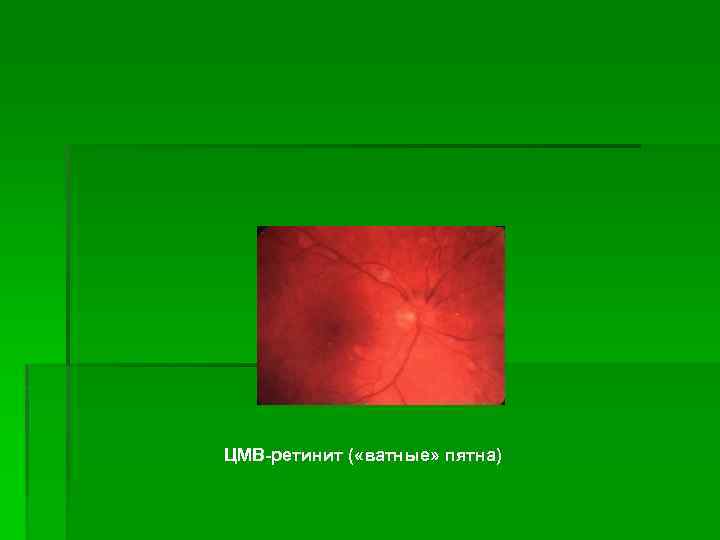 ЦМВ-ретинит ( «ватные» пятна) 