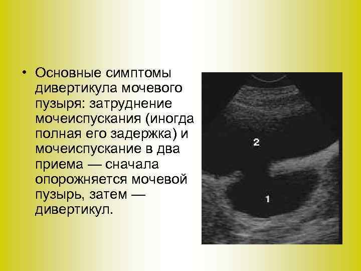  • Основные симптомы дивертикула мочевого пузыря: затруднение мочеиспускания (иногда полная его задержка) и