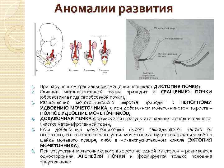 Аномалии развития 1. При нарушенном краниальном смещении возникает ДИСТОПИЯ ПОЧКИ; 2. Слияние метанефрогенной ткани