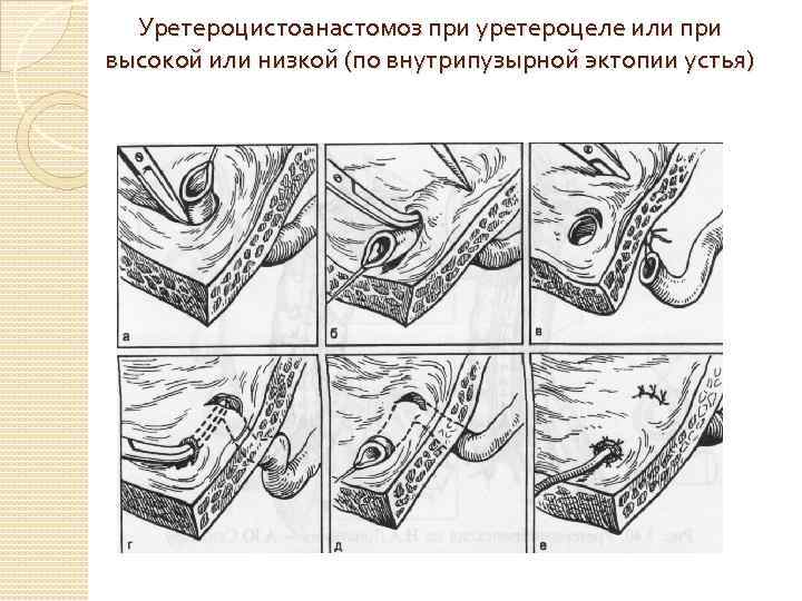 Уретероцистоанастомоз при уретероцеле или при высокой или низкой (по внутрипузырной эктопии устья) 