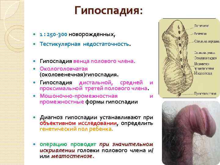 Гипоспадия: 1 : 250 -300 новорожденных, Тестикулярная недостаточность. Гипоспадия венца полового члена. Окологоловчатая (околовенечная)гипоспадия.