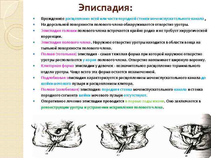Эписпадия: Врожденное расщепление всей или части передней стенки мочеиспускательного канала , На дорсальной поверхности