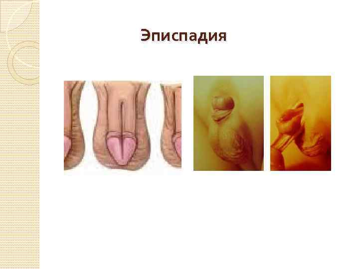 Эписпадия 
