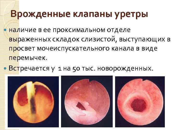 Врожденные клапаны уретры наличие в ее проксимальном отделе выраженных складок слизистой, выступающих в просвет