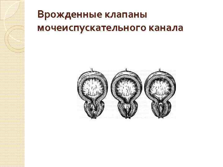 Врожденные клапаны мочеиспускательного канала 