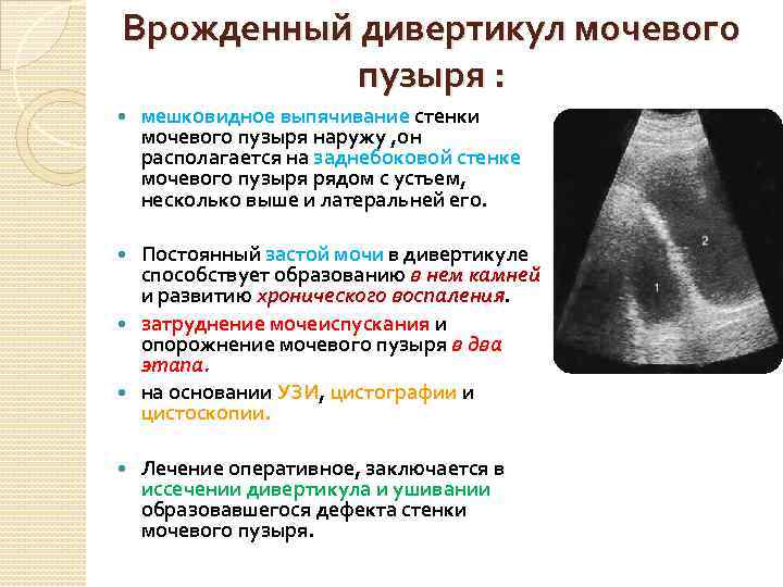 Врожденный дивертикул мочевого пузыря : мешковидное выпячивание стенки мочевого пузыря наружу , он располагается