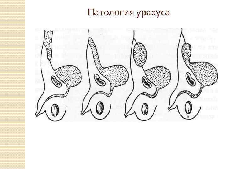 Патология урахуса 