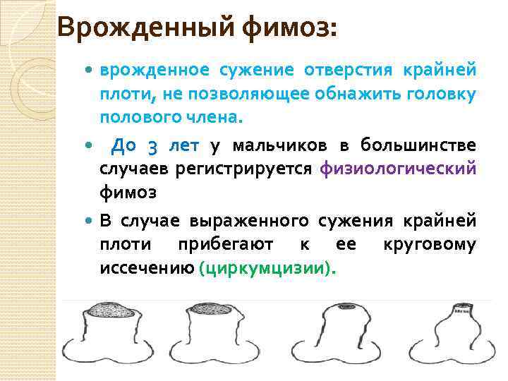 Врожденный фимоз: врожденное сужение отверстия крайней плоти, не позволяющее обнажить головку полового члена. До