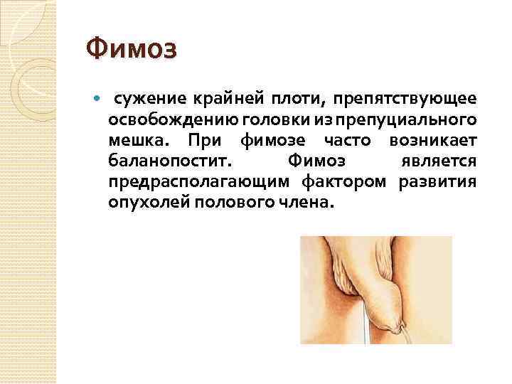 Фимоз сужение крайней плоти, препятствующее освобождению головки из препуциального мешка. При фимозе часто возникает