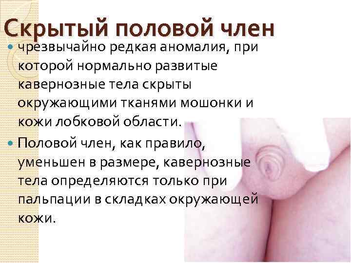 Скрытый половой член чрезвычайно редкая аномалия, при которой нормально развитые кавернозные тела скрыты окружающими