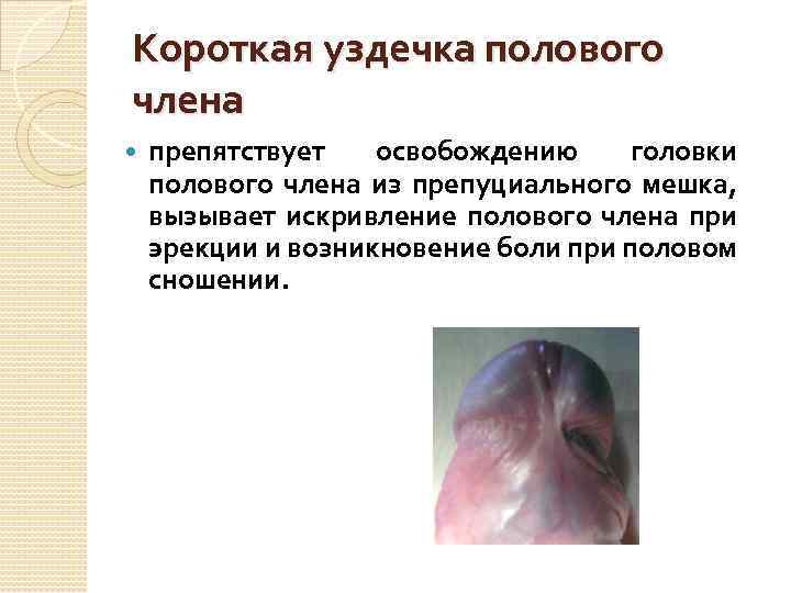 Короткая уздечка полового члена препятствует освобождению головки полового члена из препуциального мешка, вызывает искривление