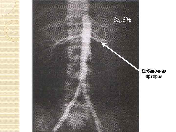 84, 6% Добавочная артерия 