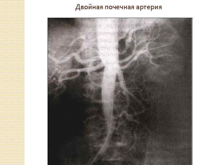 Двойная почечная артерия 