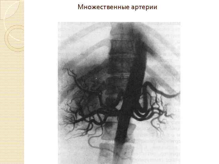 Множественные артерии 