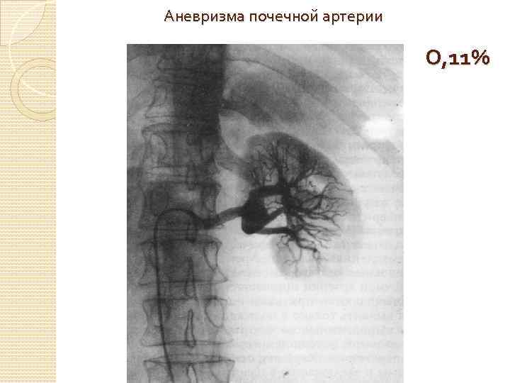 Аневризма почечной артерии О, 11% 