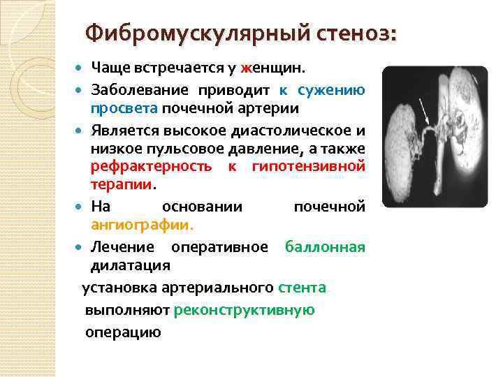 Фибромускулярный стеноз: Чаще встречается у женщин. Заболевание приводит к сужению просвета почечной артерии Является