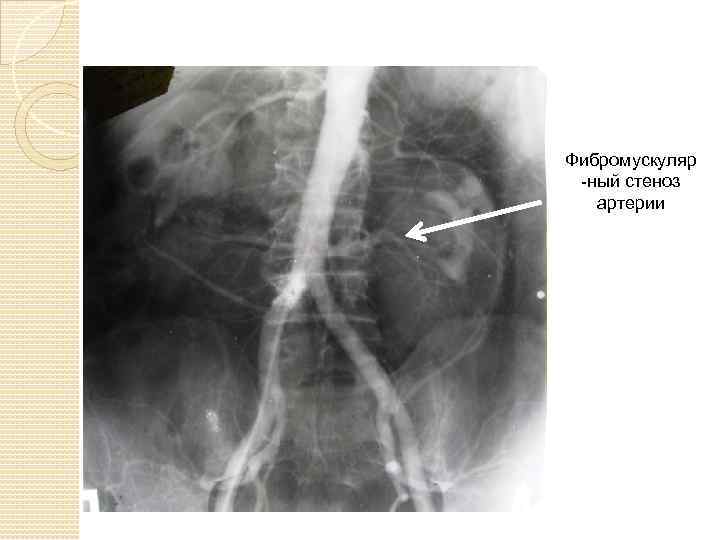 Фибромускуляр -ный стеноз артерии 
