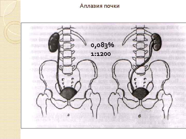 Аплазия почки 0, 083% 1: 1200 