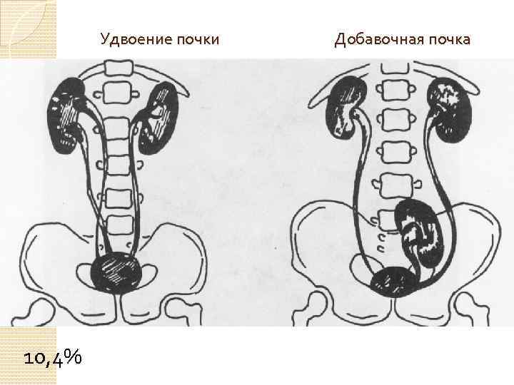 Удвоение почки 10, 4% Добавочная почка 