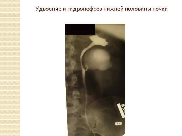 Удвоение и гидронефроз нижней половины почки 