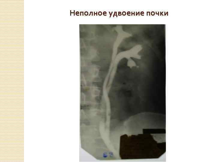 Неполное удвоение почки 