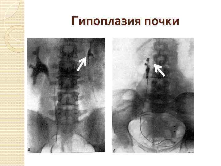 Гипоплазия почки 