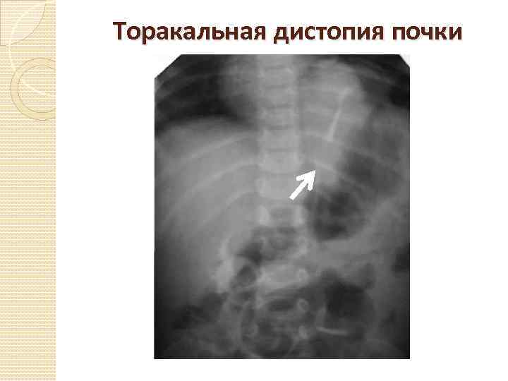 Торакальная дистопия почки 