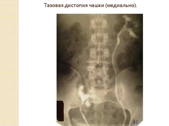 Тазовая дистопия чашки (медиально). 