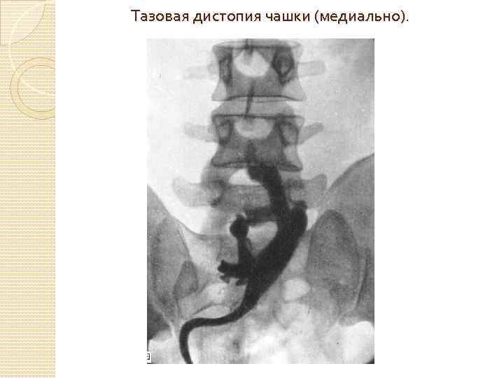 Тазовая дистопия чашки (медиально). 
