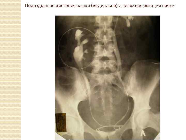 Подвздошная дистопия чашки (медиально) и неполная ротация почки 