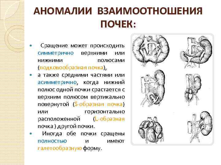 АНОМАЛИИ ВЗАИМООТНОШЕНИЯ ПОЧЕК: Сращение может происходить симметрично верхними или нижними полюсами (подковообразная почка), а