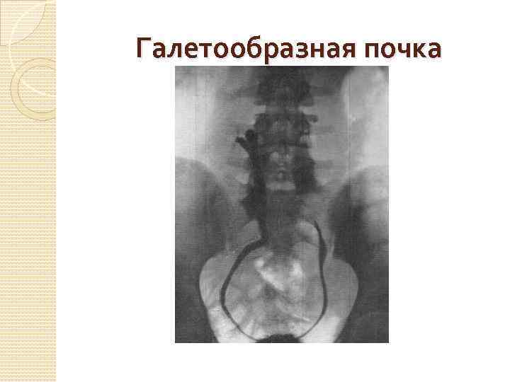 Галетообразная почка 