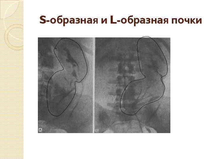 S-образная и L-образная почки 