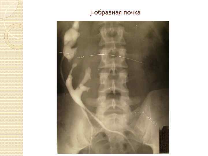 J-образная почка 