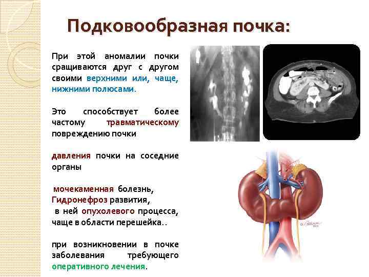 Подковообразная почка: При этой аномалии почки сращиваются друг с другом своими верхними или, чаще,