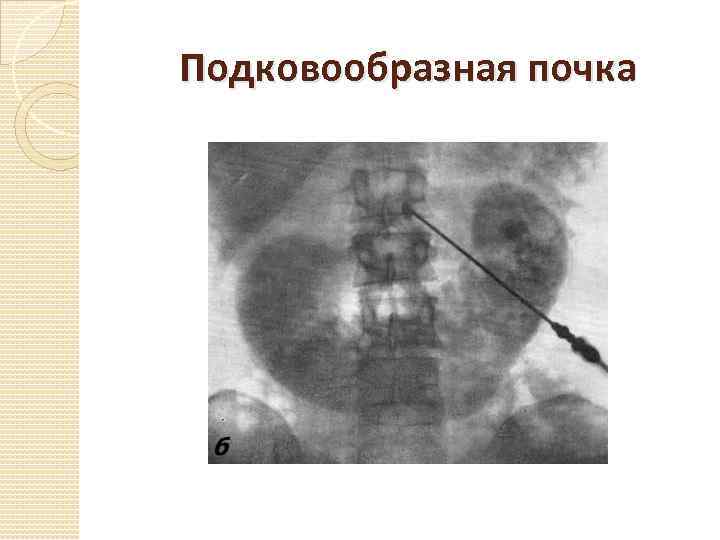 Подковообразная почка 